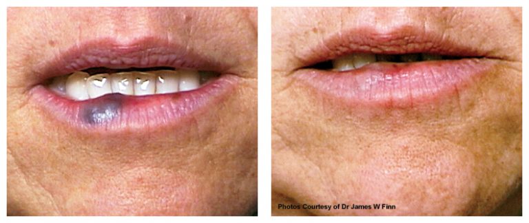 Cilt Dolgusunun Yan Etkileri