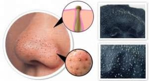 Gözenek Sıkılaştırma Yöntemleri