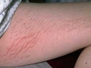 Hangi Ciltlerde Çatlak Çok Görülür