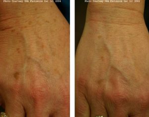 Lazer ile Cilt Lekesi Tedavisi