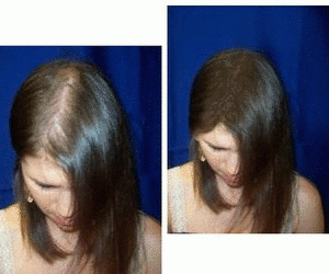 Saç Çıkaran Maske