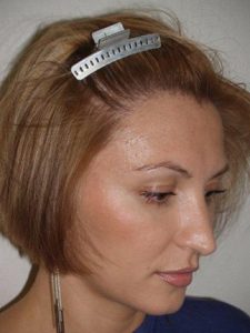 Saç nakli restorasyonu