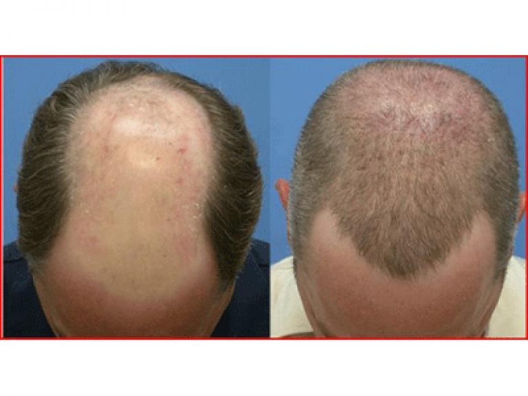 Erkeklerde Saç Ekimi