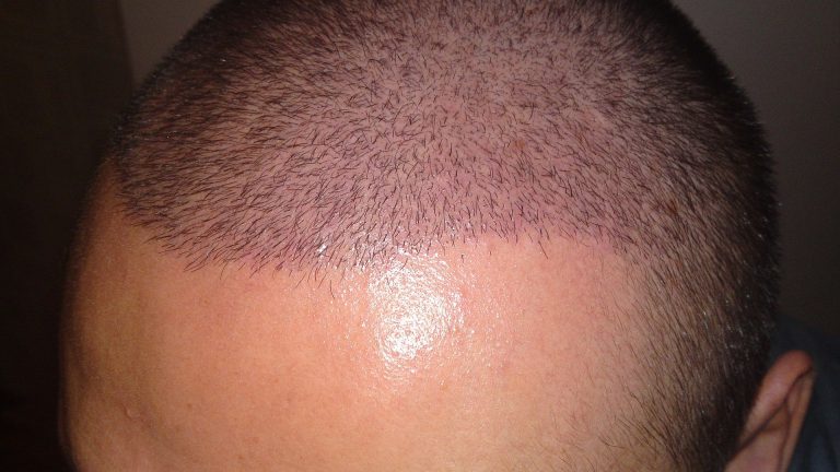 Yaz Aylarında Saç Ekimi