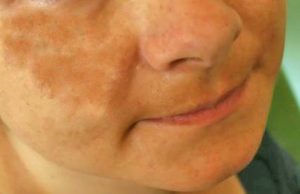 Güneş Lekelerine Mucize Çözüm