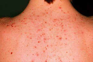 Sırttaki sivilceler ve tedavisi