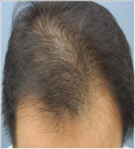 Saç Dökülmesinin (Kellik) Nedenleri