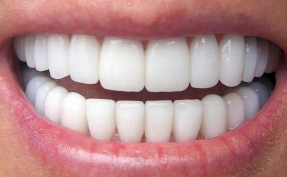 Implant Dişler Estetik Görünür Mü