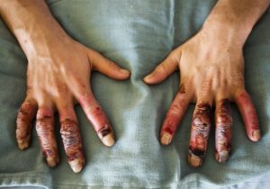 Soğuk Havalardaki Tehlike: Soğuk Isırması