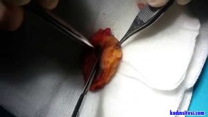 Kıl Dönmesi Nedir, Kıl Dönmesi Neden Olur?