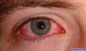 Gözde Görülen Alerjik Konjonktivit Hastalığı Nedir?