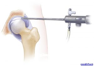 Artroskopik Cerrahi Nedir?
