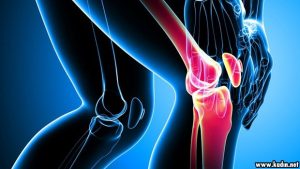 Eklem Kireçlenmesi Nasıl Bir Rahatsızlıktır?