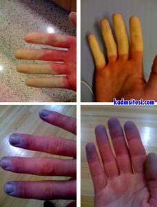 Raynaud Hastalığı Nedir?