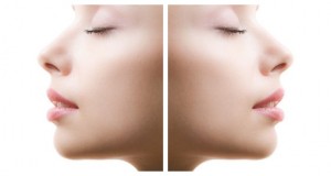 Kadına burun estetiği nasıl yapılmalı