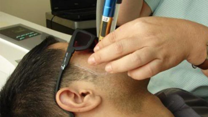 Erkekler Lazer Epilasyon Tercih Ediyor
