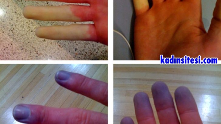 Raynaud Hastalığı Nedir?