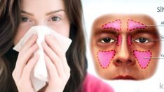 Sinüzit Nedir?
