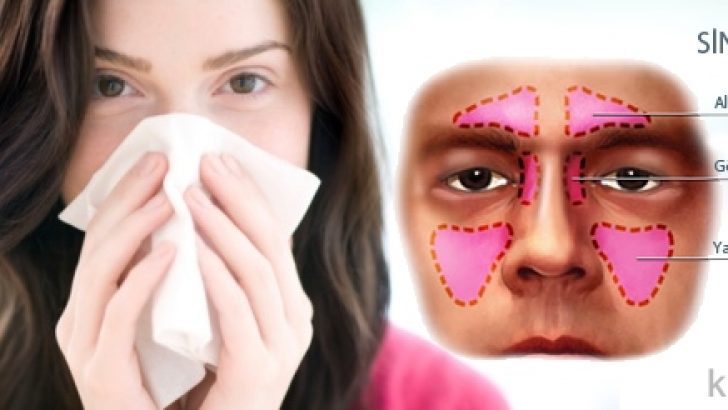 Sinüzit Nedir?