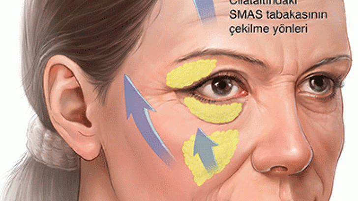 Alın Germe Estetik Ameliyatı