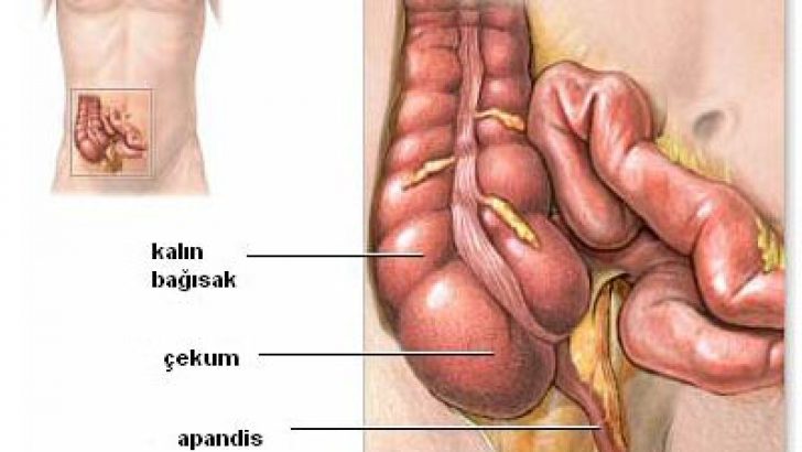 Apandisit