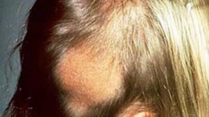 Алопеция у ребенка причины и лечение фото После Лучевой Терапии Выпадают Волосы Или Нет